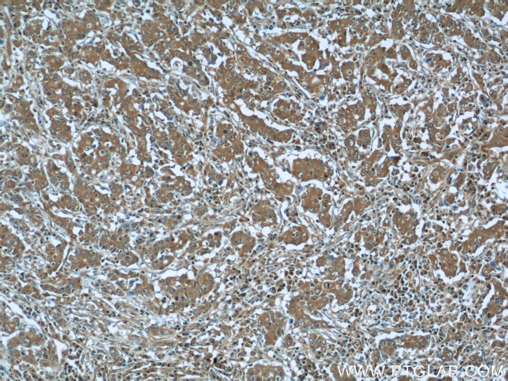 Immunohistochemistry (IHC) staining of human stomach cancer tissue using RRP7A Polyclonal antibody (24490-1-AP)