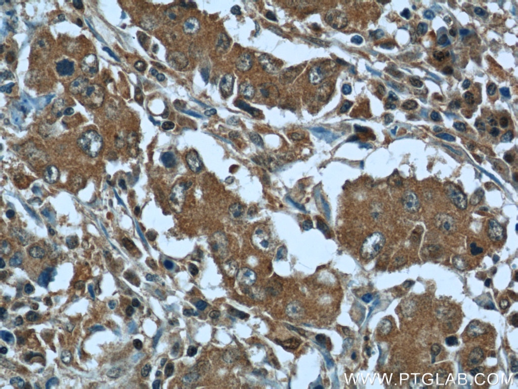 Immunohistochemistry (IHC) staining of human stomach cancer tissue using RRP7A Polyclonal antibody (24490-1-AP)