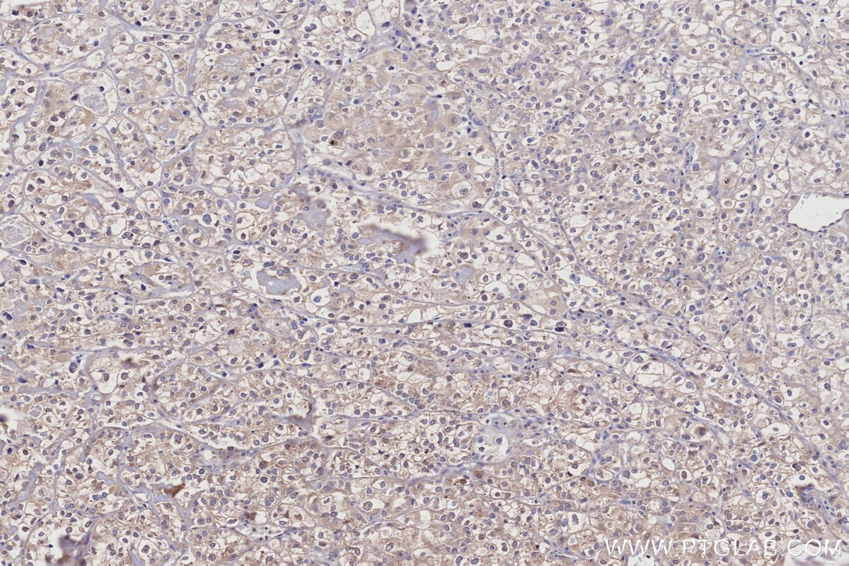 Immunohistochemistry (IHC) staining of human endometrial cancer tissue using RSPH1 Polyclonal antibody (32033-1-AP)