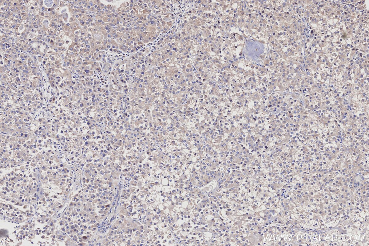 Immunohistochemistry (IHC) staining of human endometrial cancer tissue using RSPH1 Polyclonal antibody (32033-1-AP)