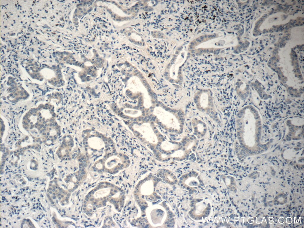 Immunohistochemistry (IHC) staining of human lung cancer tissue using RSPO3 Polyclonal antibody (17193-1-AP)