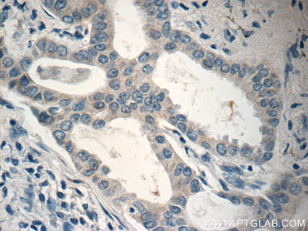 Immunohistochemistry (IHC) staining of human lung cancer tissue using RSPO3 Polyclonal antibody (17193-1-AP)