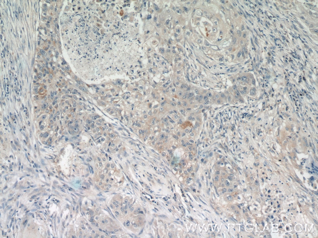 Immunohistochemistry (IHC) staining of human lung cancer tissue using RSPO3 Polyclonal antibody (17193-1-AP)