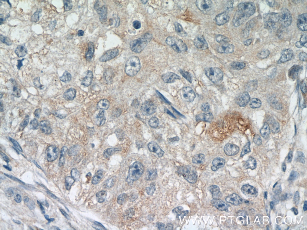 Immunohistochemistry (IHC) staining of human lung cancer tissue using RSPO3 Polyclonal antibody (17193-1-AP)