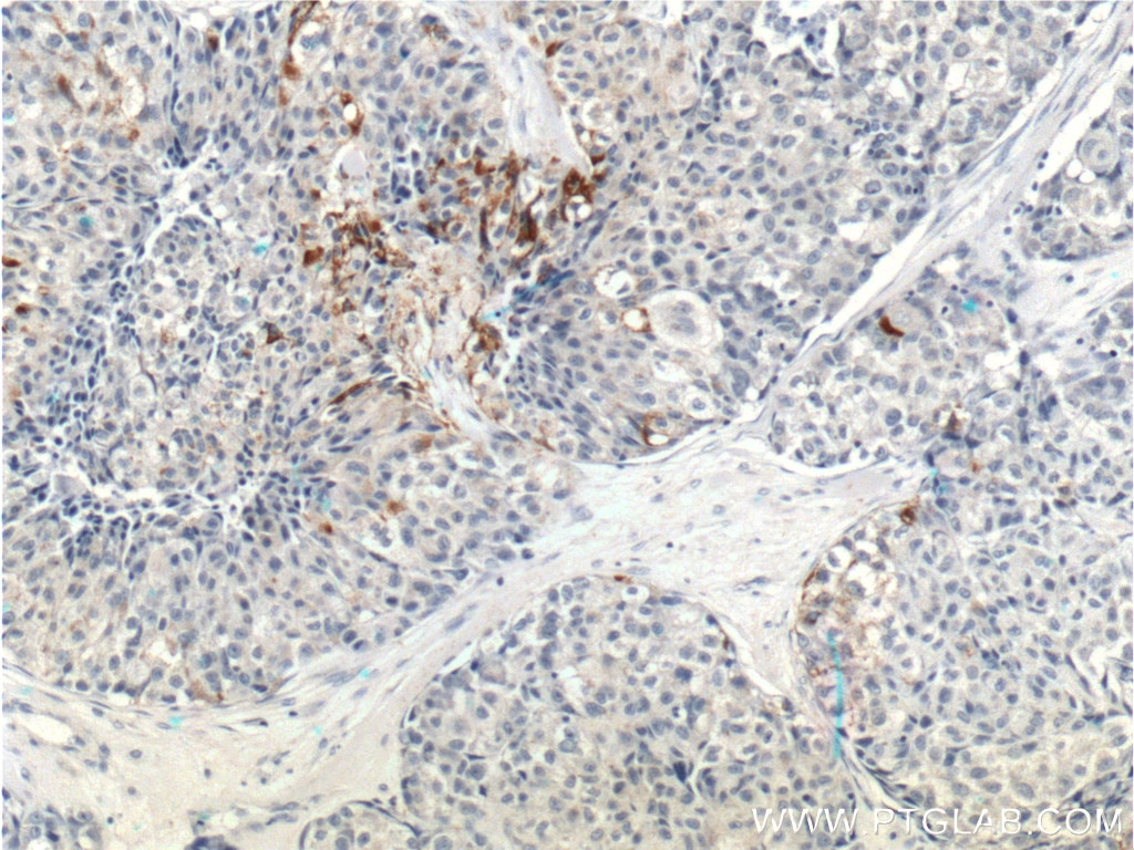 Immunohistochemistry (IHC) staining of human lung cancer tissue using RSPO3 Polyclonal antibody (17193-1-AP)