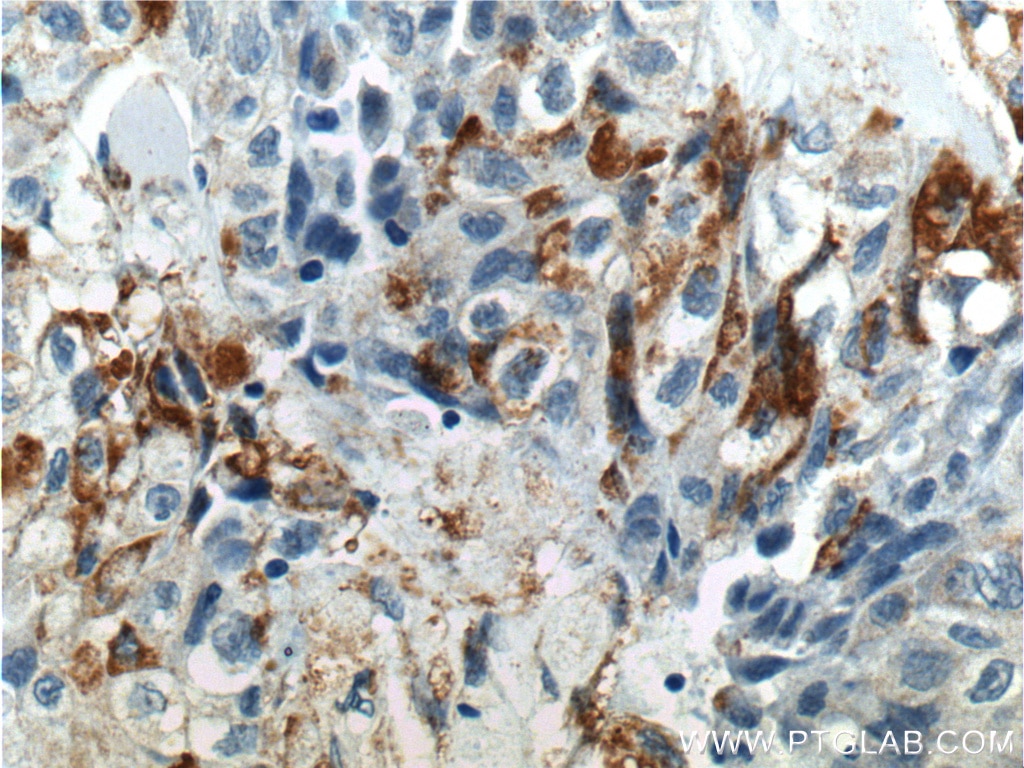 IHC staining of human lung cancer using 17193-1-AP
