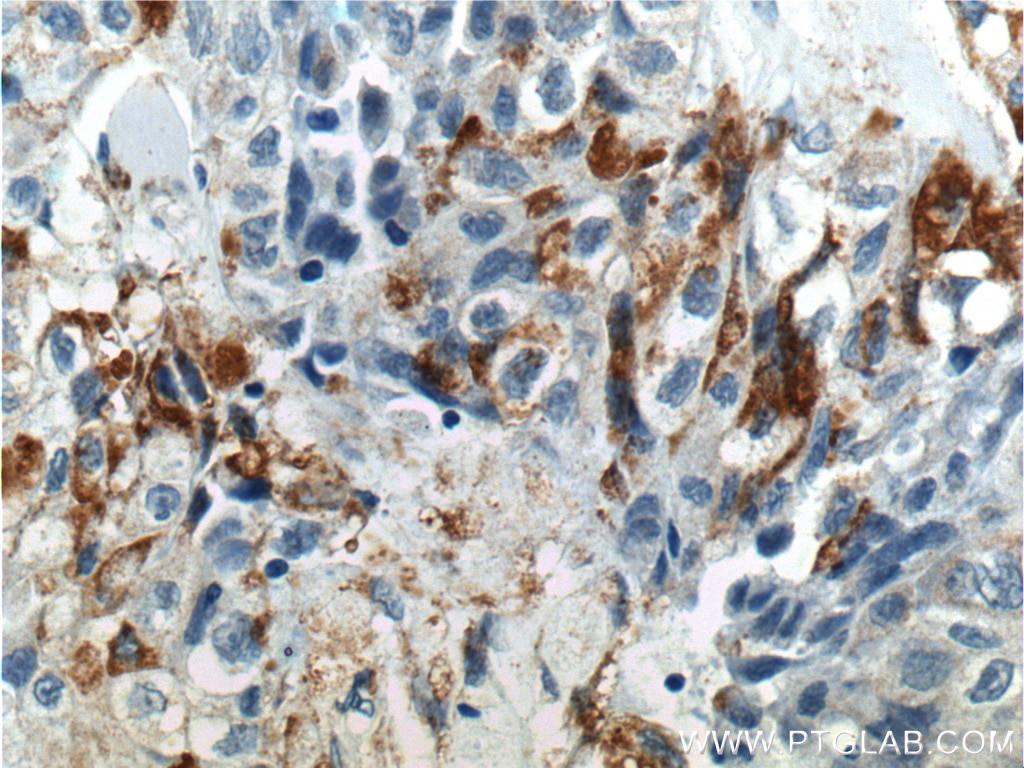 Immunohistochemistry (IHC) staining of human lung cancer tissue using RSPO3 Polyclonal antibody (17193-1-AP)