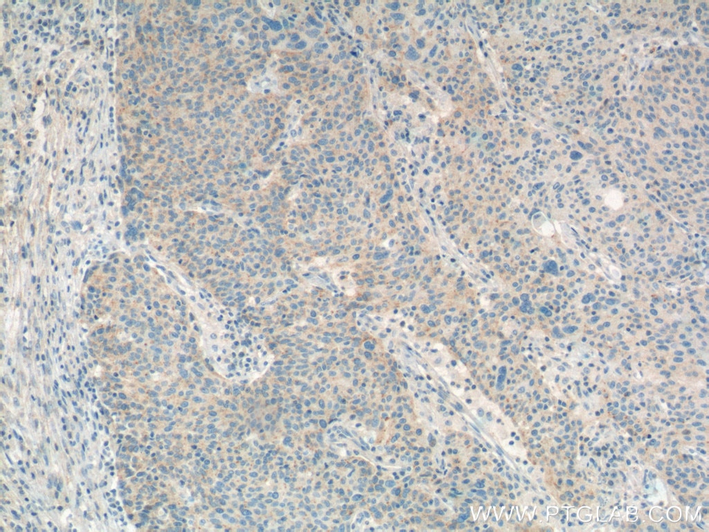 Immunohistochemistry (IHC) staining of human lung cancer tissue using RSPO3 Monoclonal antibody (66314-1-Ig)