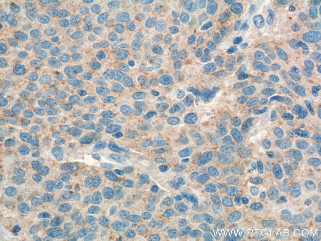 Immunohistochemistry (IHC) staining of human lung cancer tissue using RSPO3 Monoclonal antibody (66314-1-Ig)