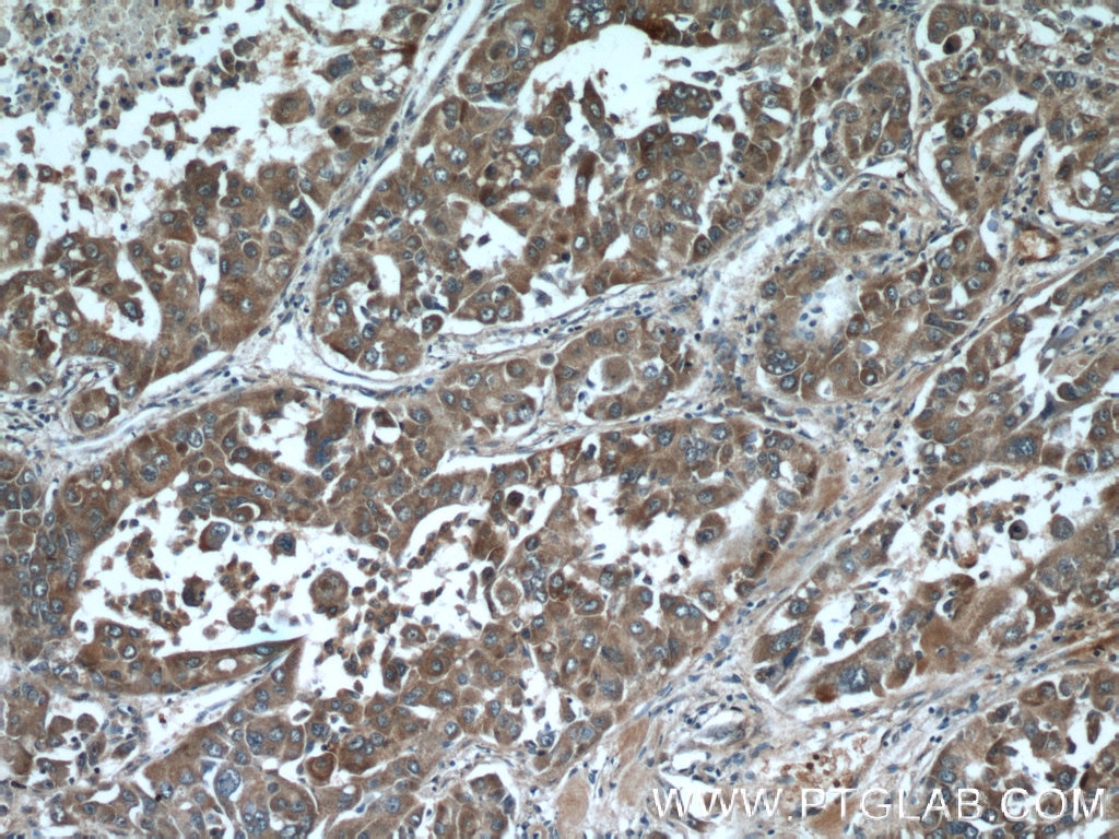 IHC staining of human liver cancer using 23826-1-AP