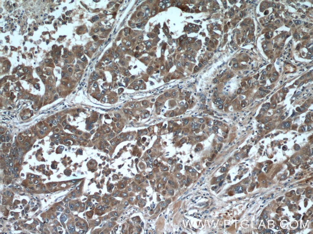 Immunohistochemistry (IHC) staining of human liver cancer tissue using RSRC1 Polyclonal antibody (23826-1-AP)