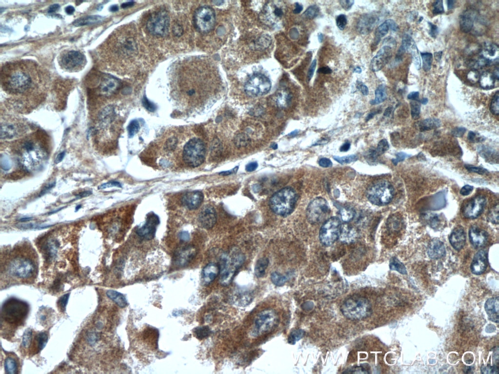 Immunohistochemistry (IHC) staining of human liver cancer tissue using RSRC1 Polyclonal antibody (23826-1-AP)