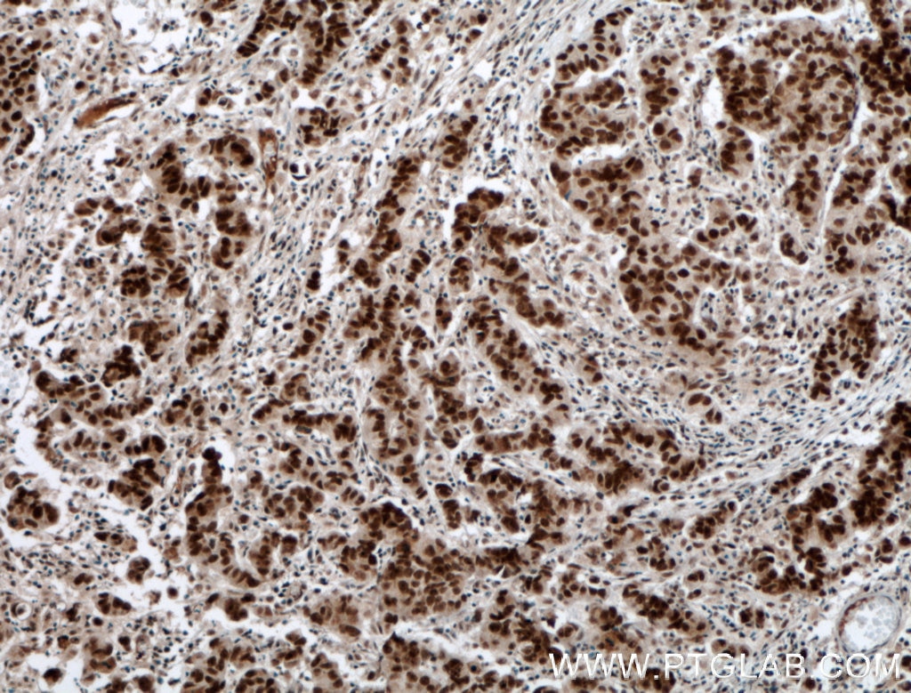 Immunohistochemistry (IHC) staining of human prostate cancer tissue using RTF1 Polyclonal antibody (12170-1-AP)