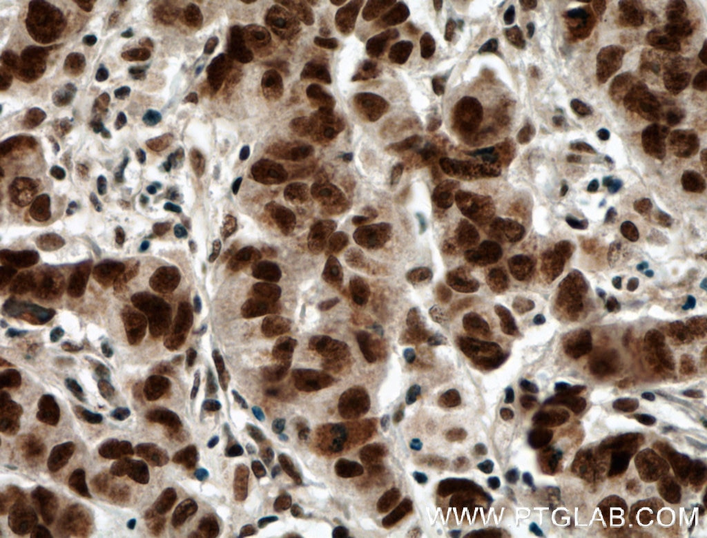 Immunohistochemistry (IHC) staining of human prostate cancer tissue using RTF1 Polyclonal antibody (12170-1-AP)