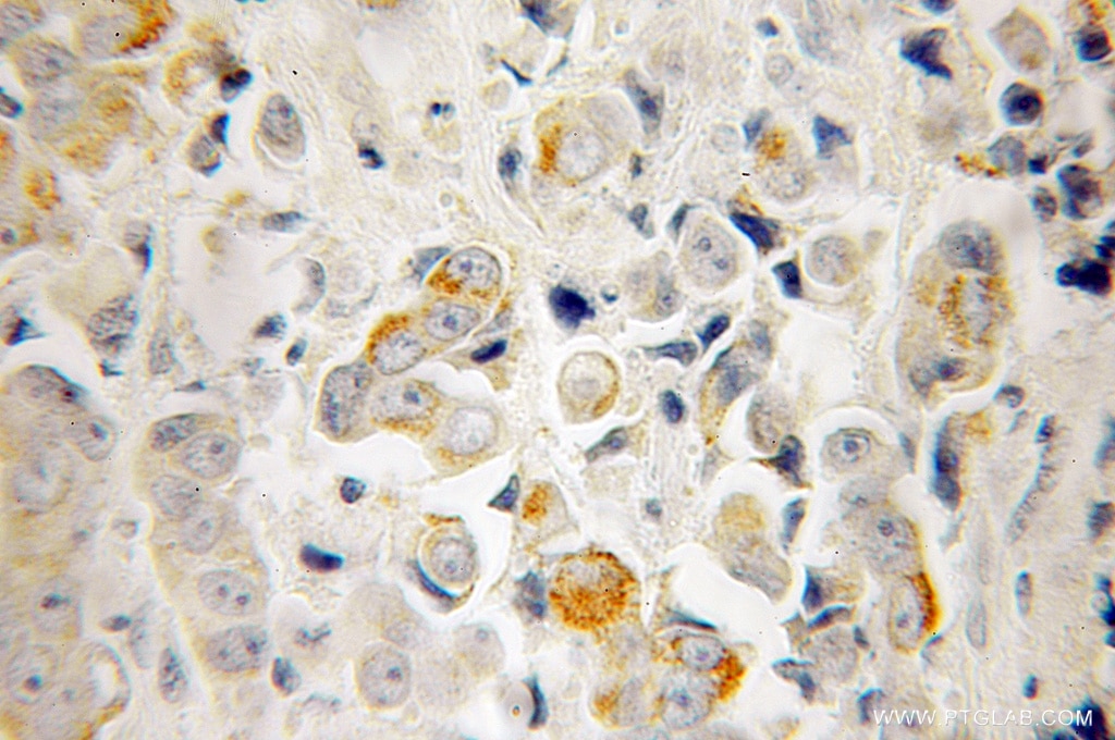 Immunohistochemistry (IHC) staining of human prostate cancer tissue using RTKN Polyclonal antibody (12762-1-AP)