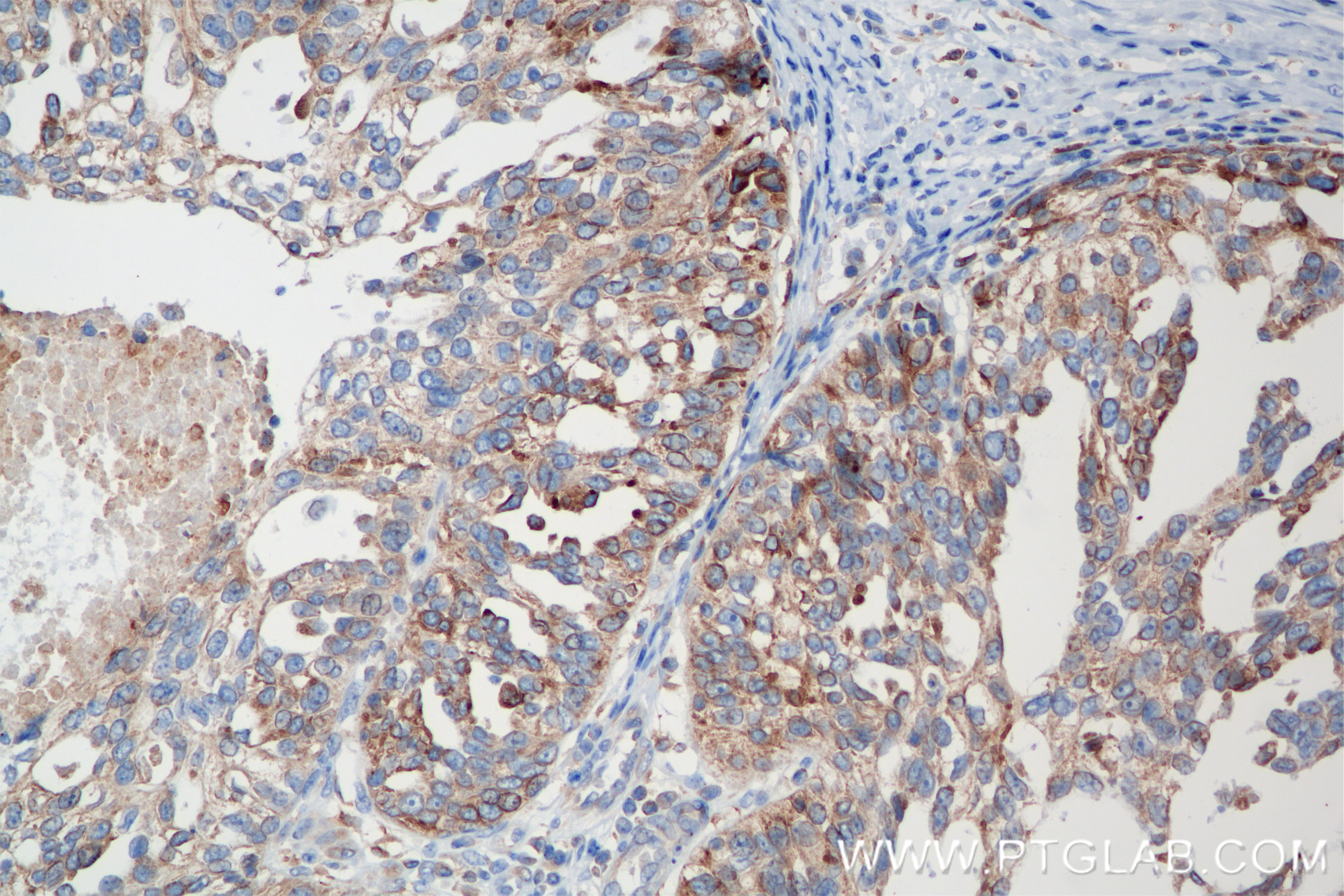Immunohistochemistry (IHC) staining of human ovary cancer tissue using RTN2 Recombinant antibody (86162-1-RR)