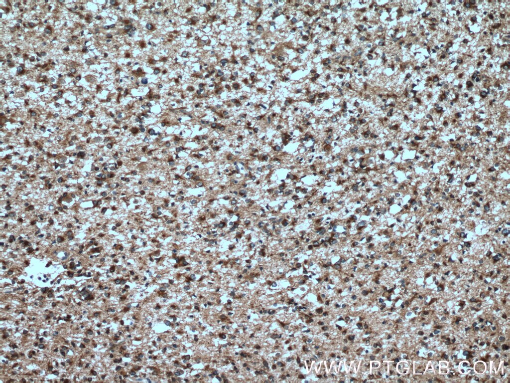 Immunohistochemistry (IHC) staining of human gliomas tissue using RTN3 Polyclonal antibody (12055-2-AP)