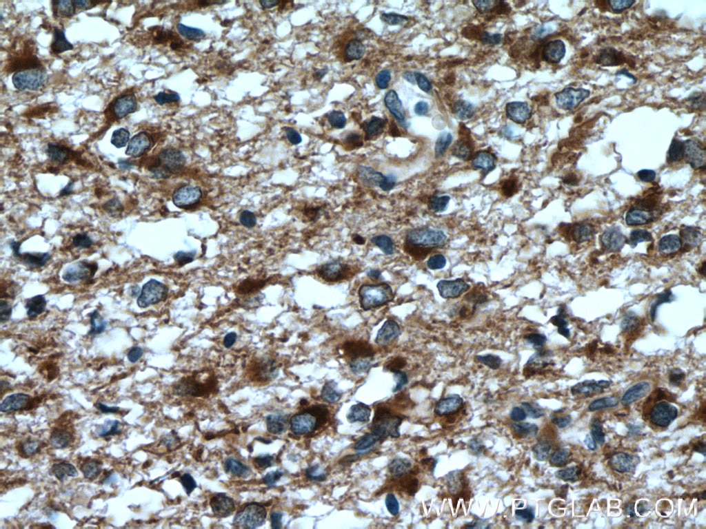 IHC staining of human gliomas using 12055-2-AP