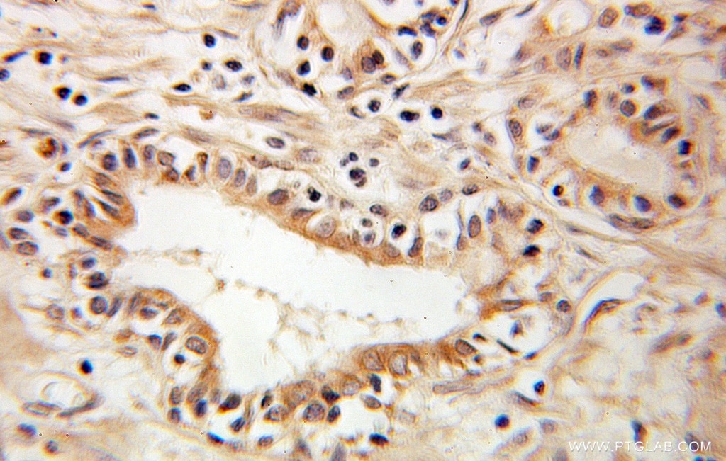 Immunohistochemistry (IHC) staining of human prostate cancer tissue using RTN4/NOGO Polyclonal antibody (10740-1-AP)