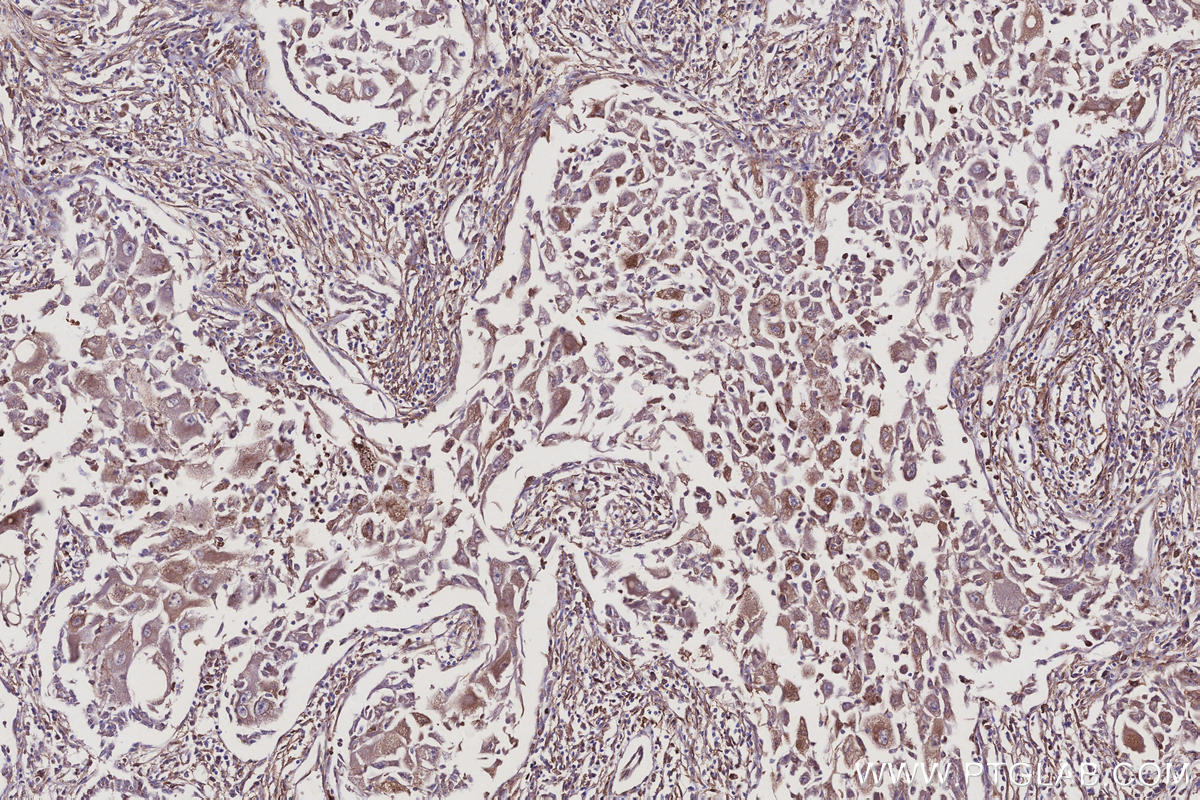 IHC staining of human lung cancer using 10950-1-AP Immunohistochemistry (IHC) staining of human lung cancer tissue using RTN4/NOGO Polyclonal antibody (10950-1-AP)