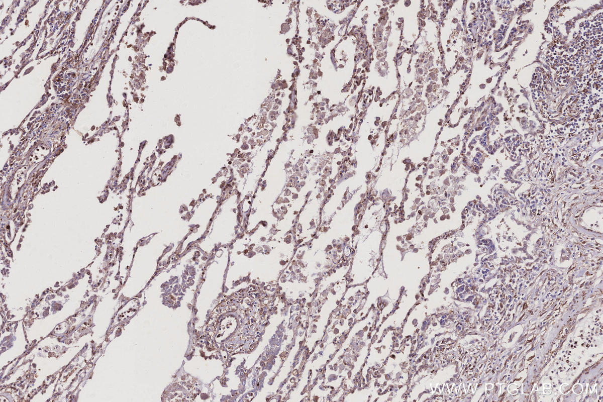 IHC staining of human lung cancer using 10950-1-AP Immunohistochemistry (IHC) staining of human lung cancer tissue using RTN4/NOGO Polyclonal antibody (10950-1-AP)