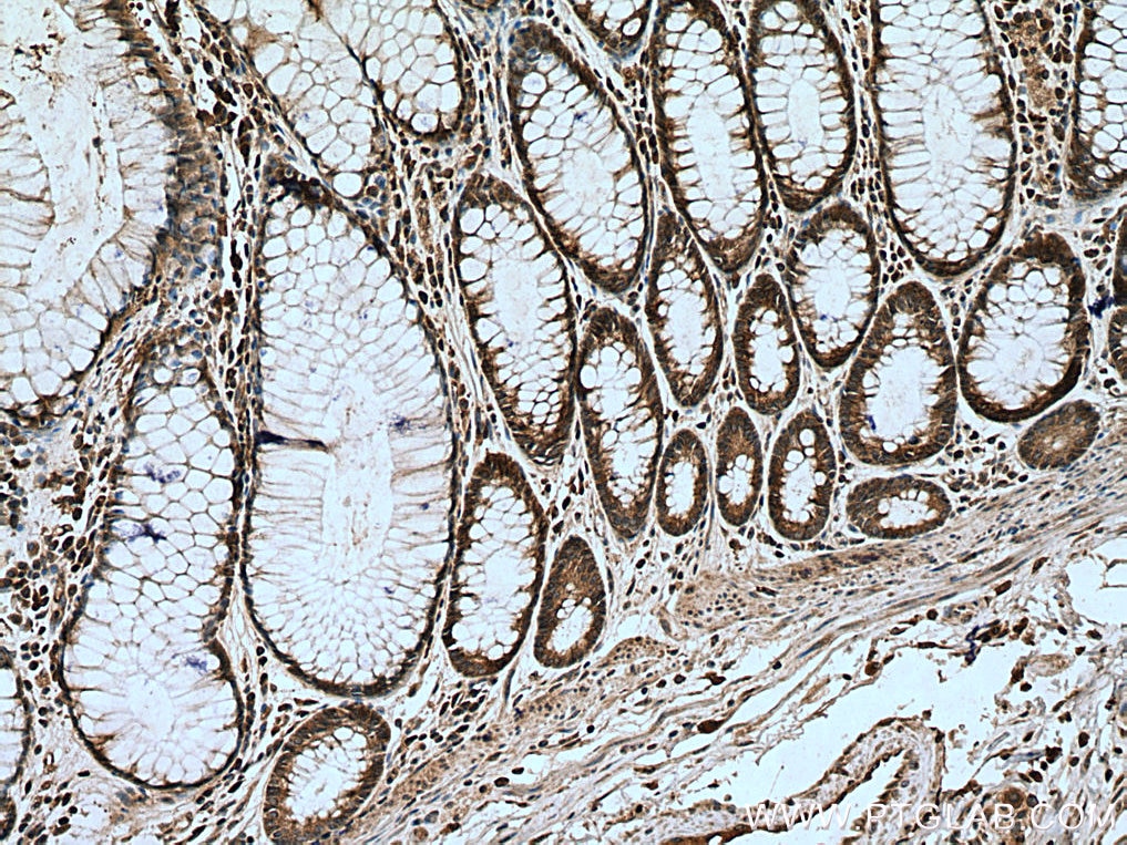 IHC staining of human colon cancer using 17267-1-AP