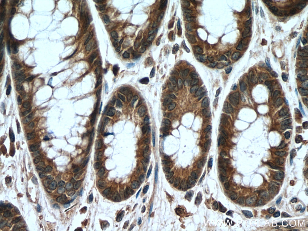 Immunohistochemistry (IHC) staining of human colon cancer tissue using RUNDC1 Polyclonal antibody (17267-1-AP)