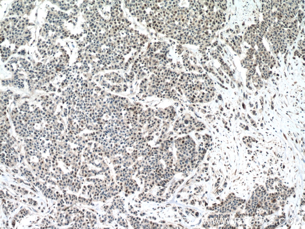 Immunohistochemistry (IHC) staining of human colon cancer tissue using RUNX1 (middle) Polyclonal antibody (25315-1-AP)