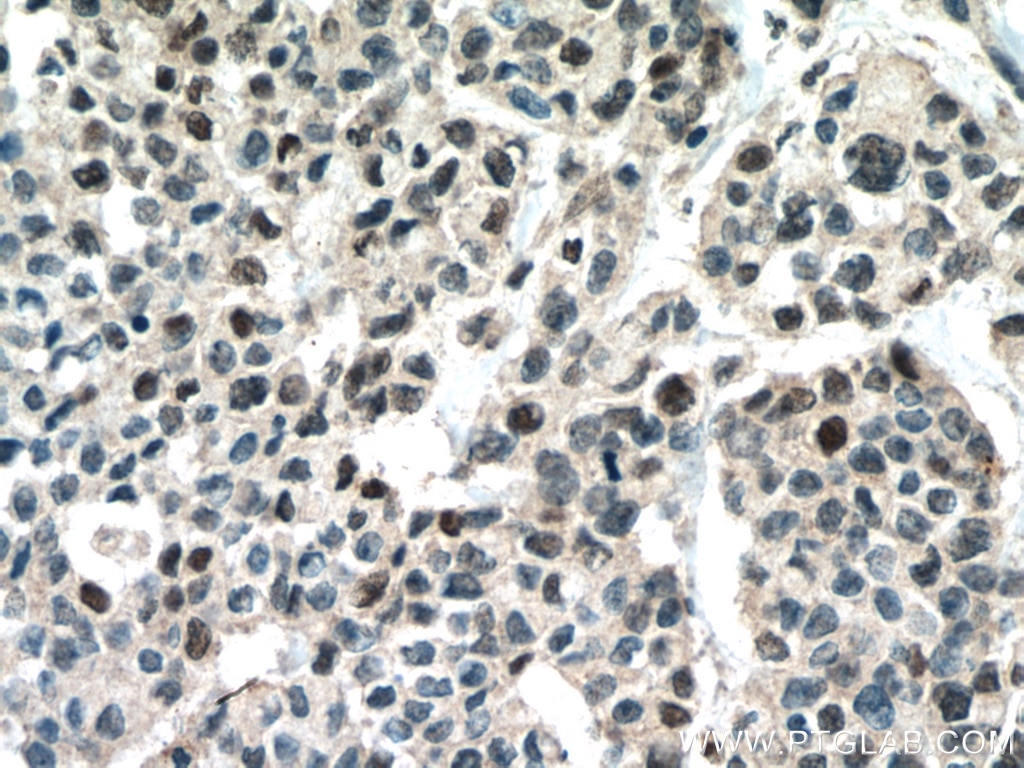 Immunohistochemistry (IHC) staining of human colon cancer tissue using RUNX1 (middle) Polyclonal antibody (25315-1-AP)