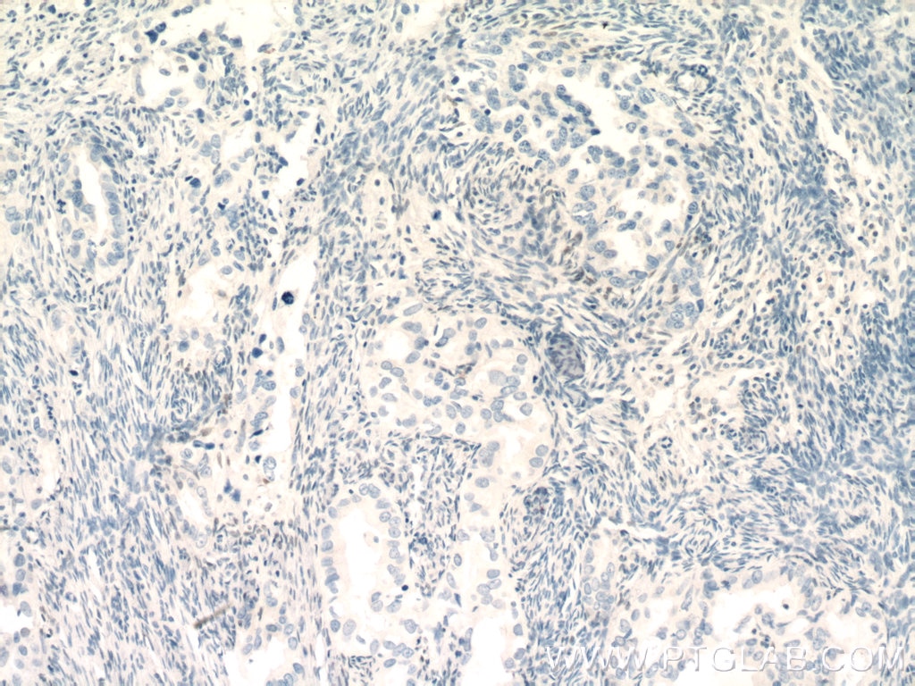 IHC staining of human ovary tumor using 25315-1-AP