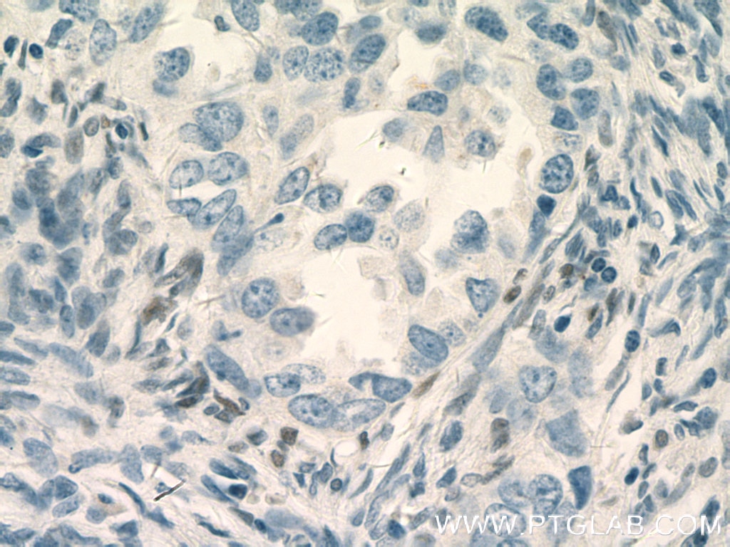Immunohistochemistry (IHC) staining of human ovary tumor tissue using RUNX1 (middle) Polyclonal antibody (25315-1-AP)