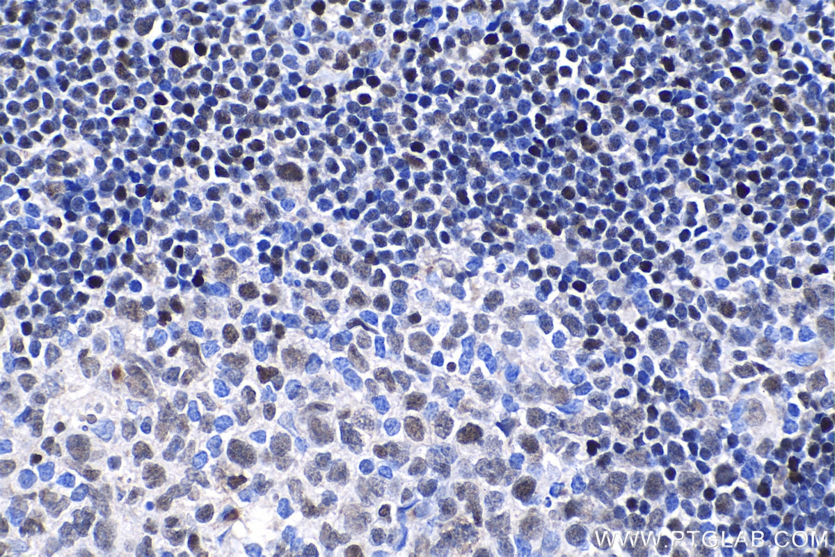 Immunohistochemistry (IHC) staining of human tonsillitis tissue using RUNX3 Polyclonal antibody (27099-1-AP)