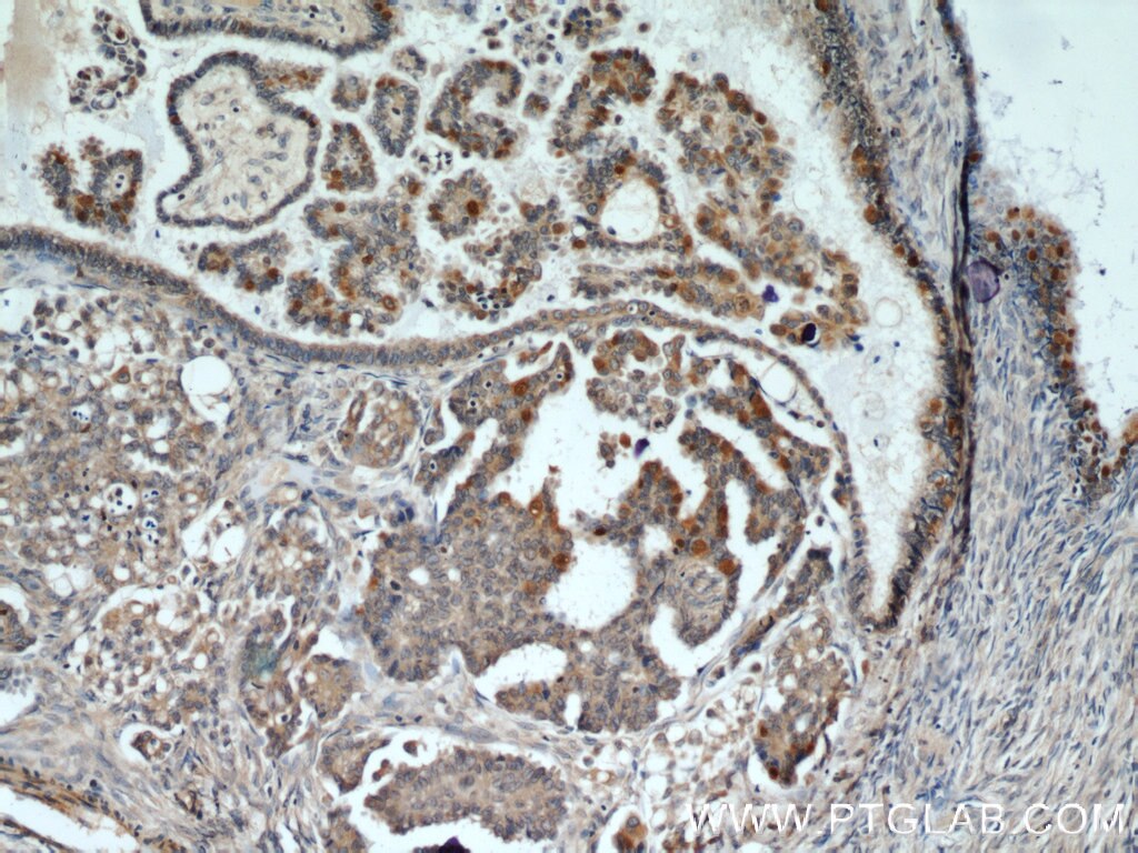 IHC staining of human ovary tumor using 10210-2-AP