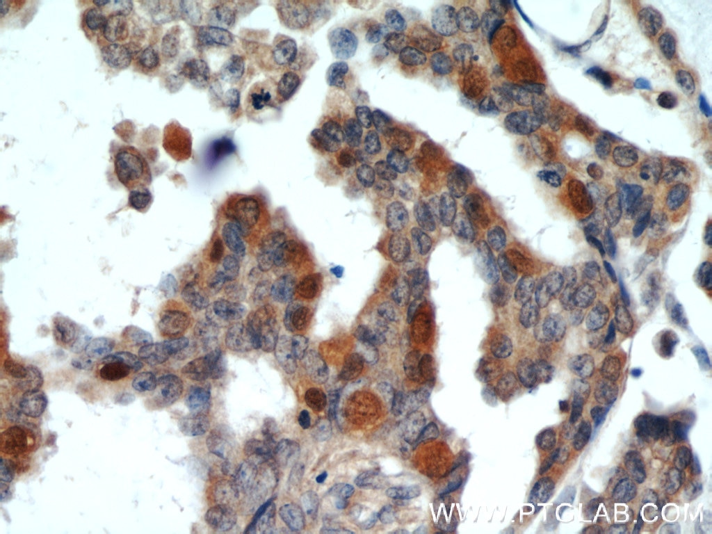Immunohistochemistry (IHC) staining of human ovary tumor tissue using RUVBL1 Polyclonal antibody (10210-2-AP)