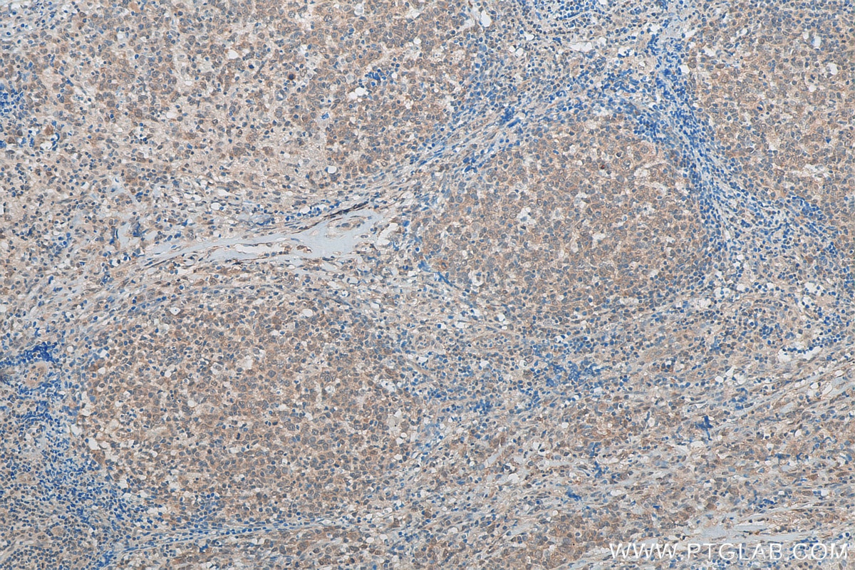 Immunohistochemistry (IHC) staining of human lymphoma tissue using RUVBL2 Polyclonal antibody (10195-1-AP)