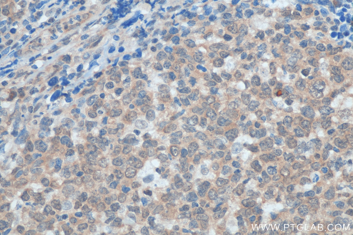 Immunohistochemistry (IHC) staining of human lymphoma tissue using RUVBL2 Polyclonal antibody (10195-1-AP)