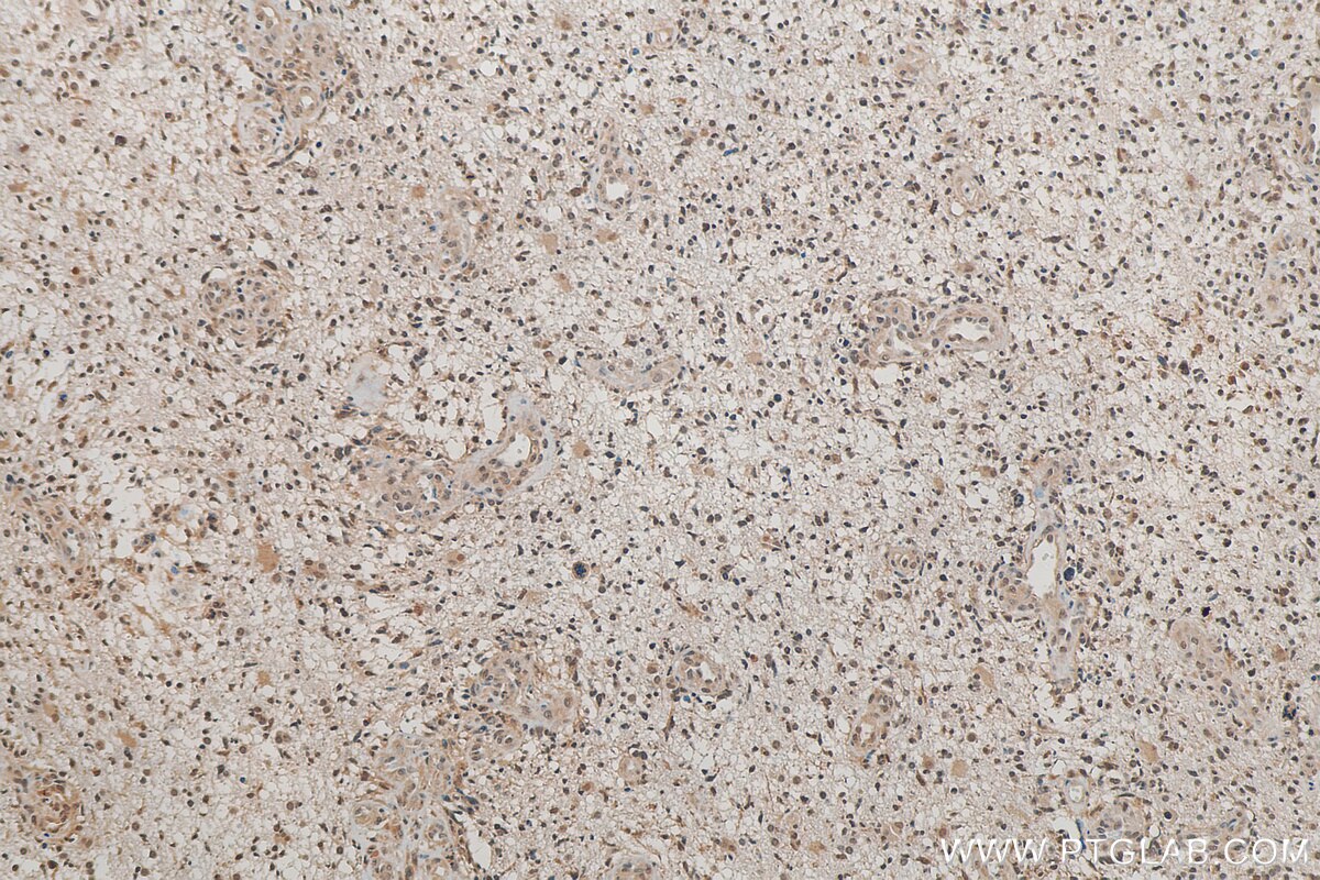 Immunohistochemistry (IHC) staining of human gliomas tissue using RUVBL2 Polyclonal antibody (10195-1-AP)