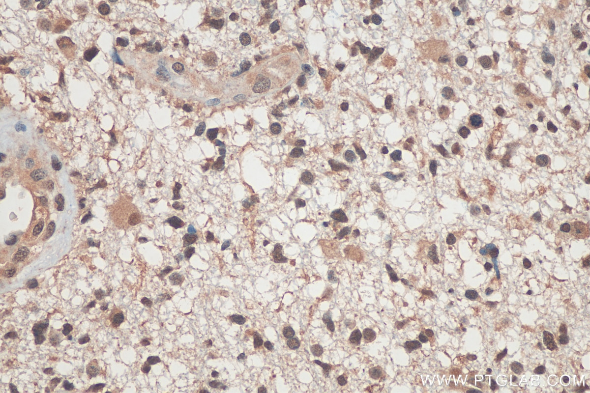 Immunohistochemistry (IHC) staining of human gliomas tissue using RUVBL2 Polyclonal antibody (10195-1-AP)