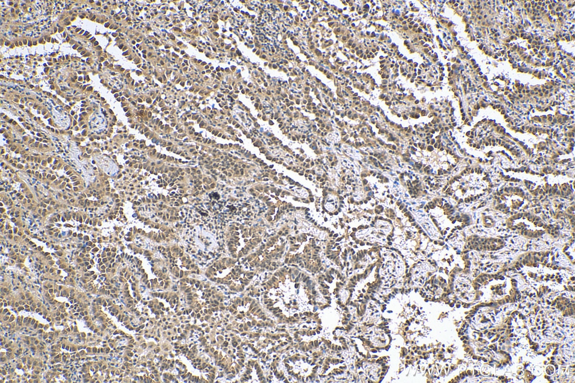 Immunohistochemistry (IHC) staining of human lung cancer tissue using RUVBL2 Monoclonal antibody (67851-1-Ig)