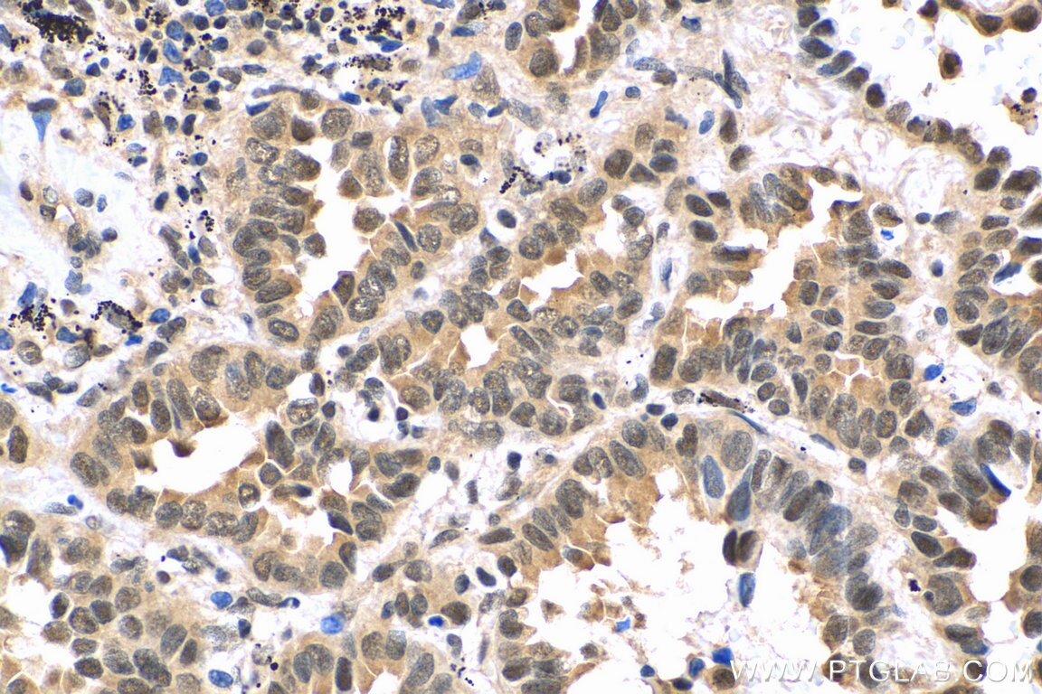 Immunohistochemistry (IHC) staining of human lung cancer tissue using RUVBL2 Monoclonal antibody (67851-1-Ig)