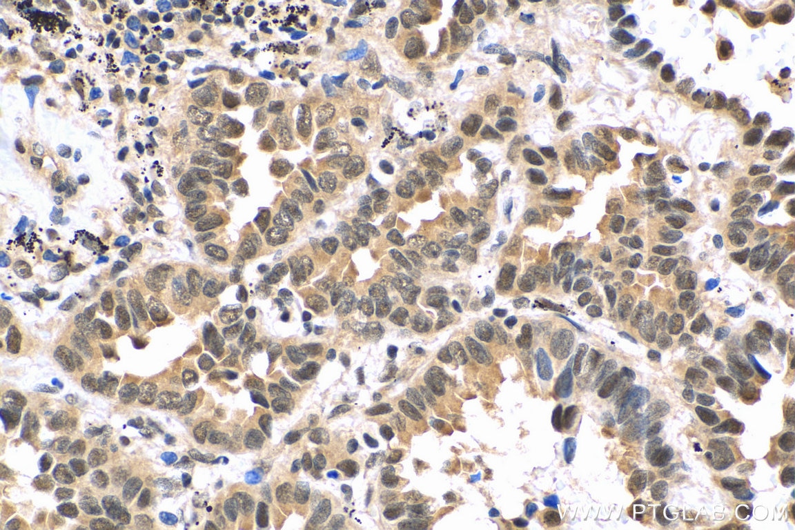 IHC staining of human lung cancer using 67851-1-Ig