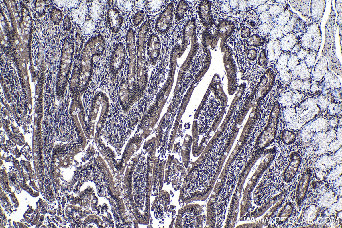 Immunohistochemistry (IHC) staining of human stomach cancer tissue using RXRA Polyclonal antibody (21218-1-AP)