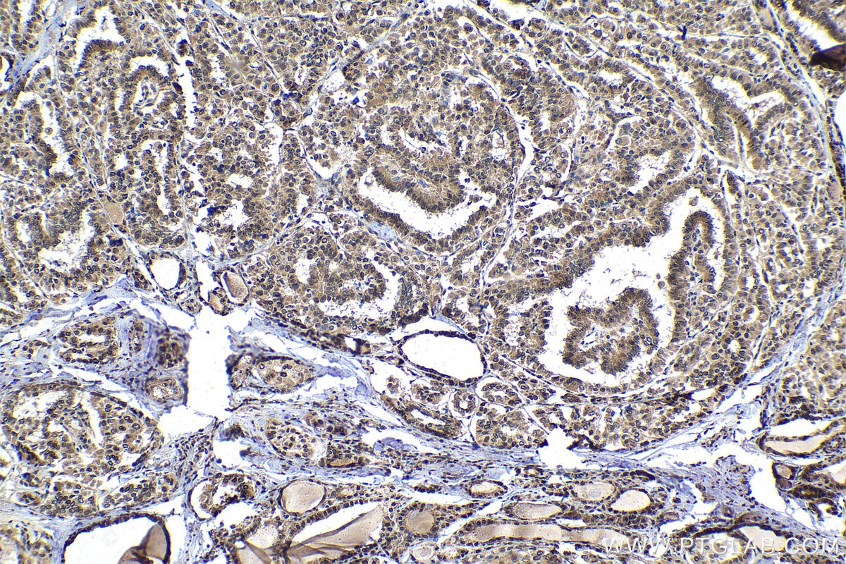 Immunohistochemistry (IHC) staining of human thyroid cancer tissue using RXRA Polyclonal antibody (21218-1-AP)