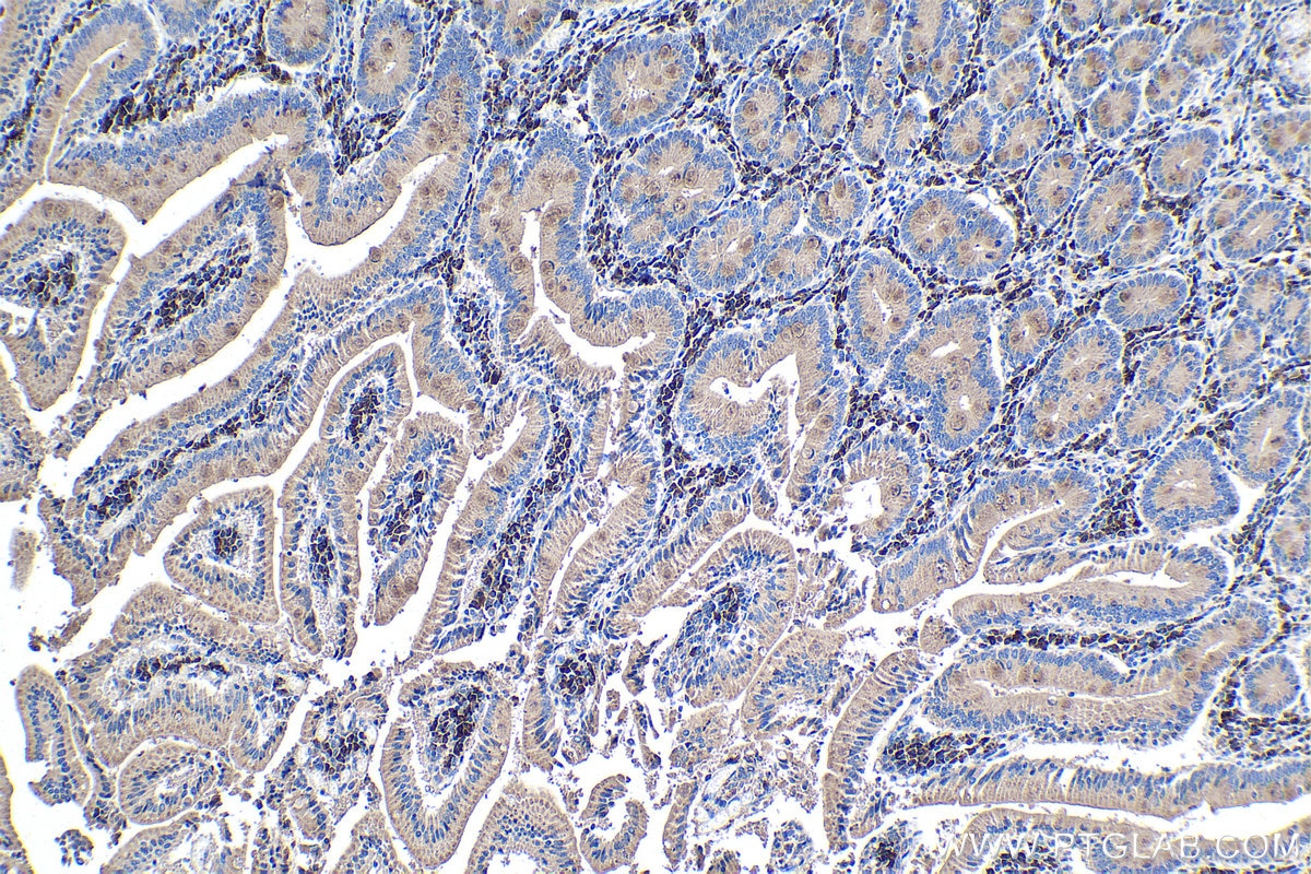 Immunohistochemistry (IHC) staining of human stomach cancer tissue using RXRA Monoclonal antibody (60198-1-Ig)