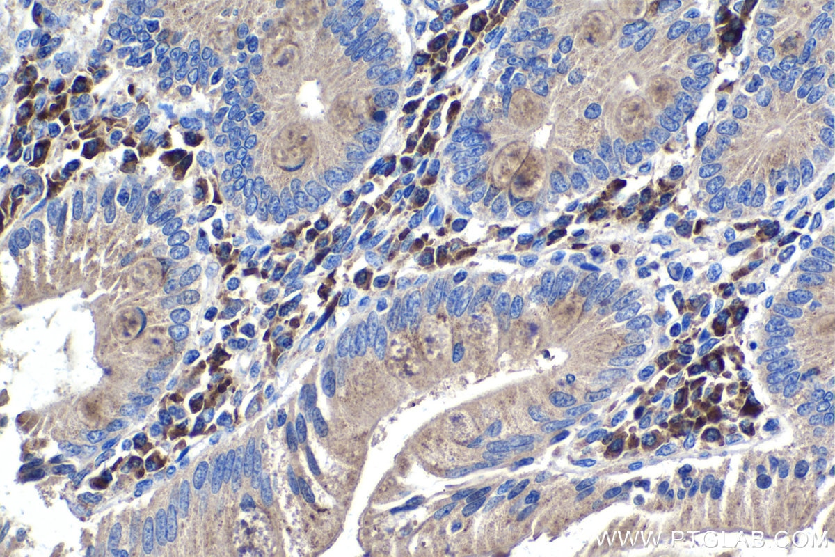 Immunohistochemistry (IHC) staining of human stomach cancer tissue using RXRA Monoclonal antibody (60198-1-Ig)