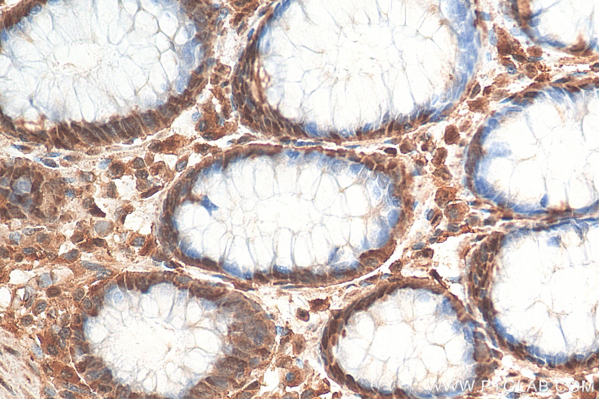 Immunohistochemistry (IHC) staining of human colon cancer tissue using RXRB Polyclonal antibody (14684-1-AP)