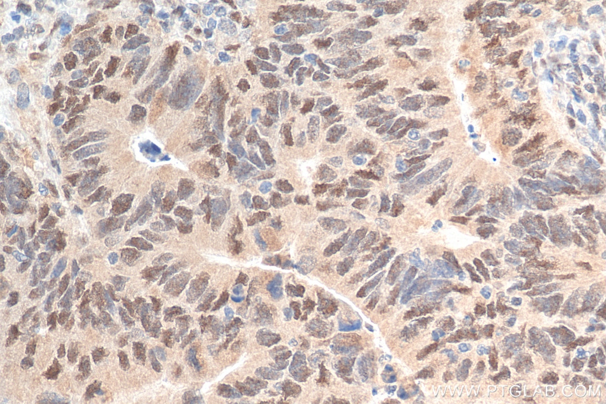 Immunohistochemistry (IHC) staining of human colon cancer tissue using RXRB Polyclonal antibody (14684-1-AP)