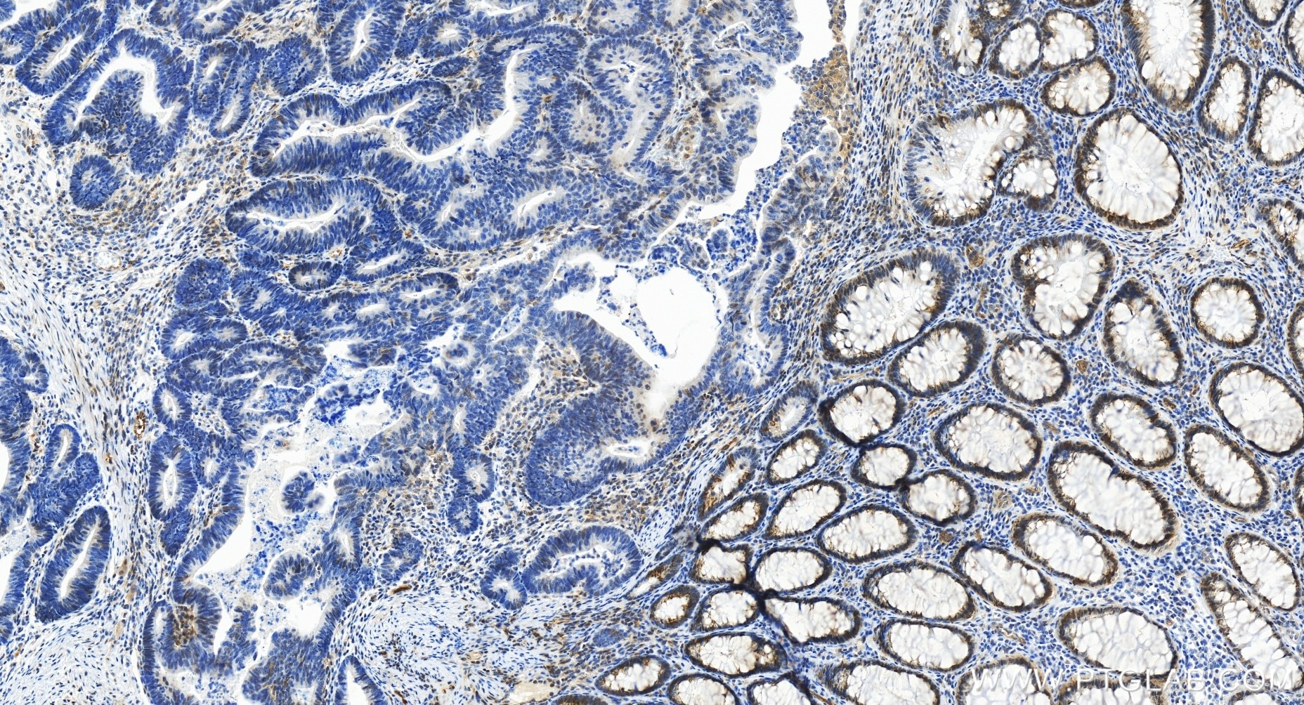 Immunohistochemistry (IHC) staining of human colon cancer tissue using RXRB Recombinant antibody (84656-4-RR)