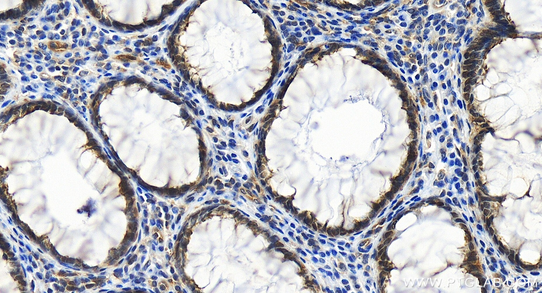 Immunohistochemistry (IHC) staining of human colon cancer tissue using RXRB Recombinant antibody (84656-4-RR)