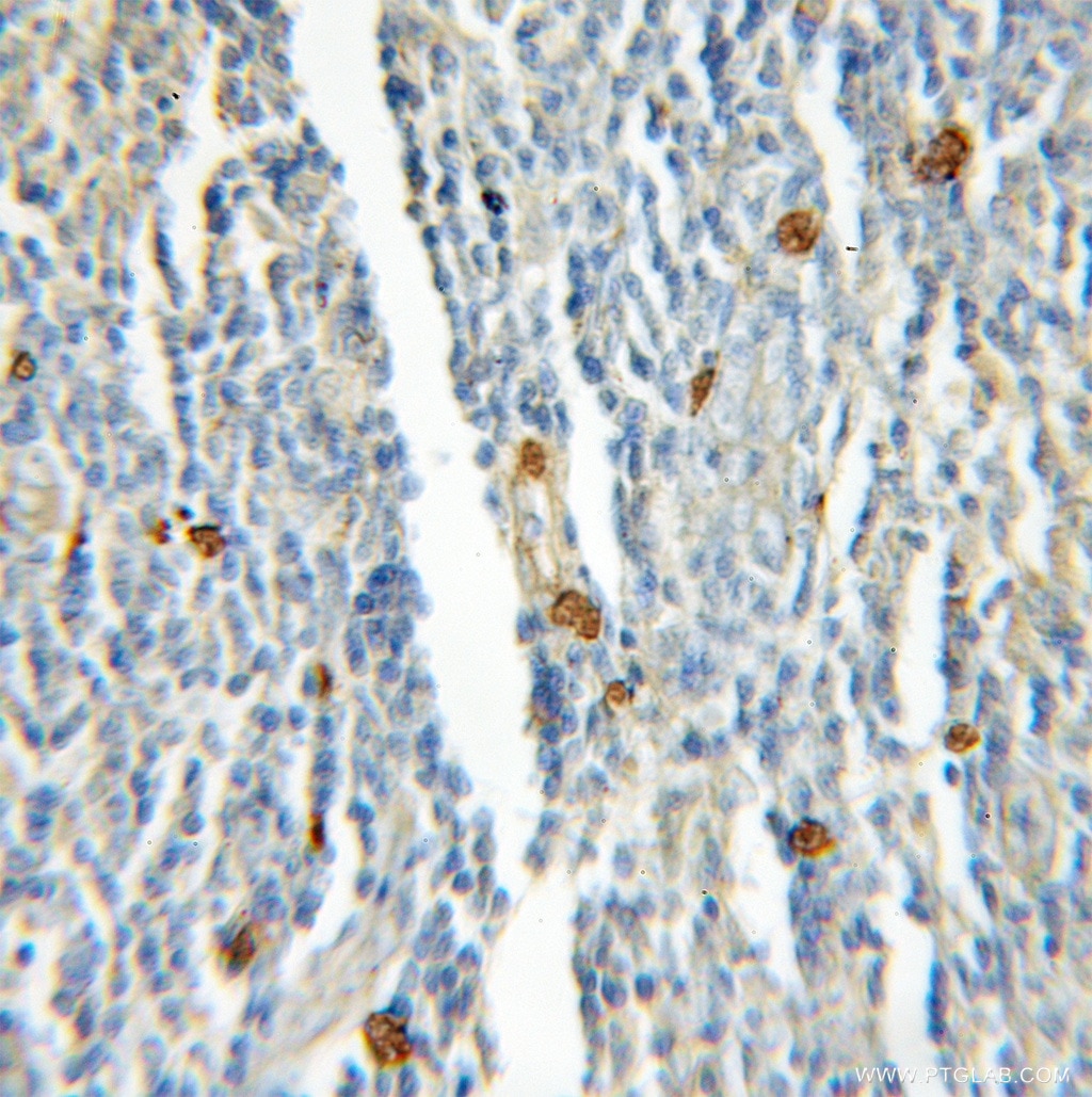 Immunohistochemistry (IHC) staining of human lymphoma tissue using Rad51D Polyclonal antibody (11126-1-AP)